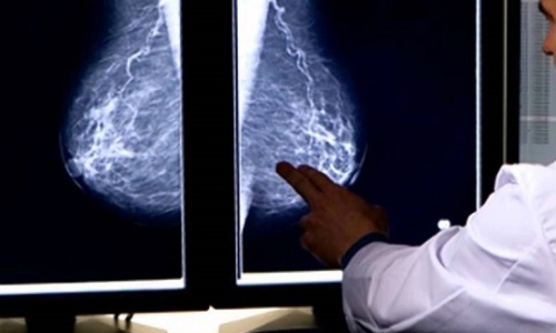 Что такое маммография с томосинтезом