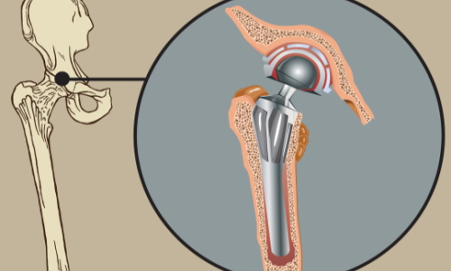 Hip arthroplasty: modern minimally invasive methods