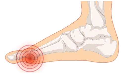 Let's talk about hallux valgus: what it is, why it occurs and how it can be treated
