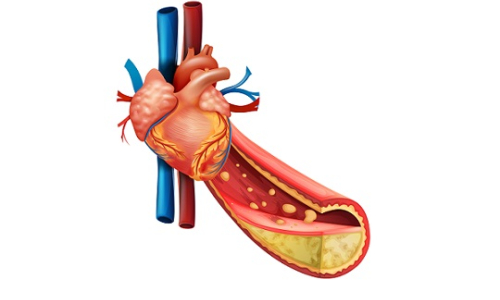 Atherosclerosis and its causes, diagnosis and treatment methods