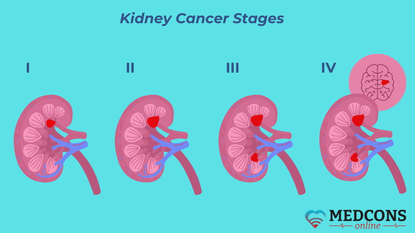 Four stages of kidney cancer