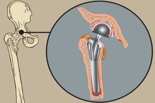 Hip arthroplasty: modern minimally invasive methods