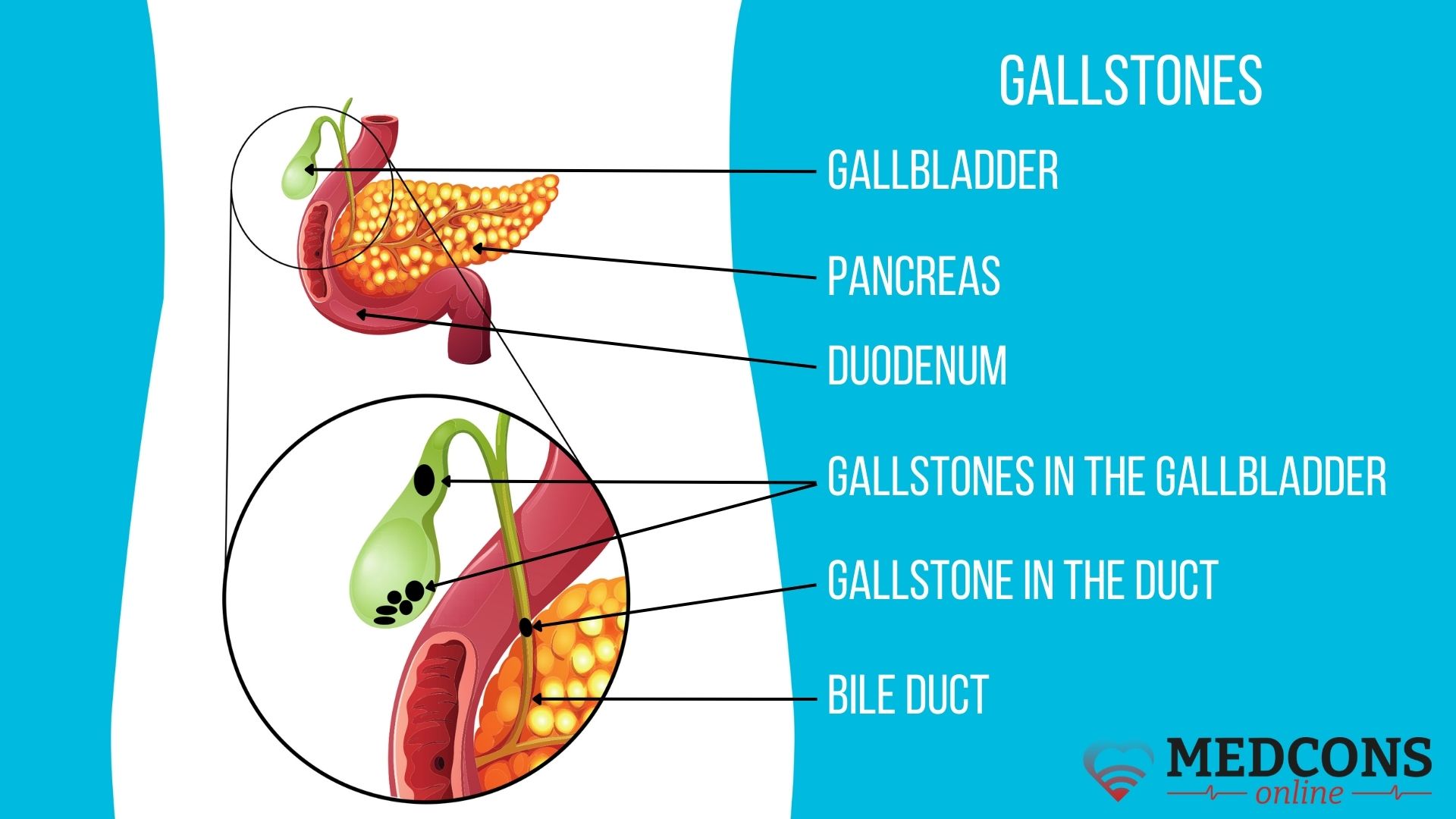 Gallstone Disease Symptoms Causes And Diagnosis At Different Stages 