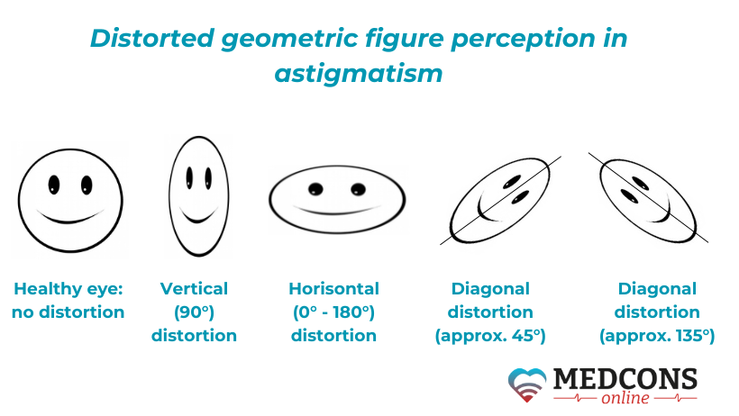 Distorted geometric figure perception in astigmatism