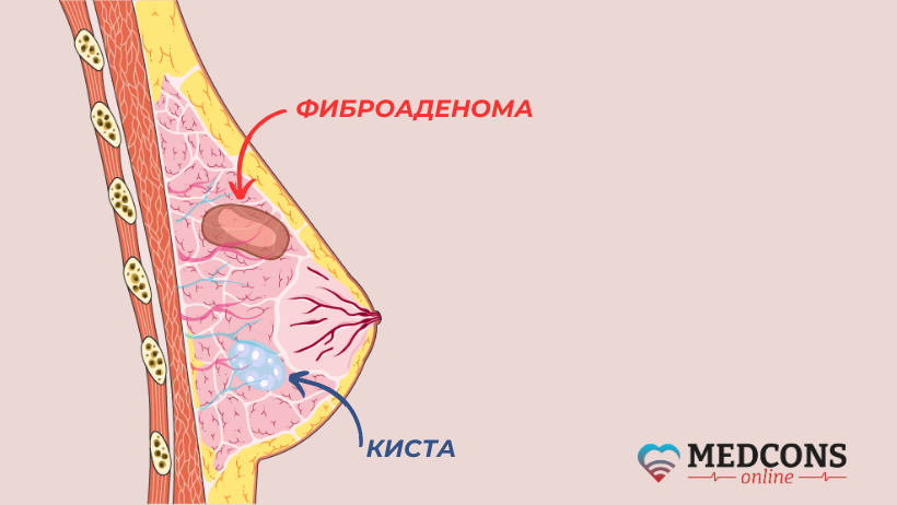 Картинка с изображением фиброаденомы и кисты в молочной железе