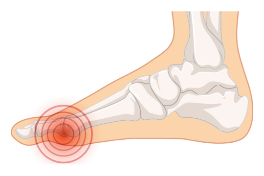 Let's talk about hallux valgus: what it is, why it occurs and how it can be treated