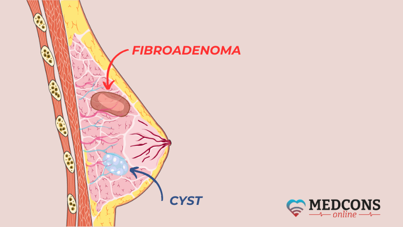 Picture showing a fibroadenoma and a cyst in the breast