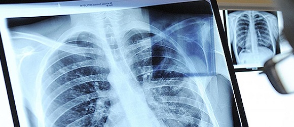 Stage IV lung cancer (carcinoma)