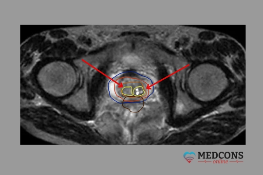 A novel method of prostate cancer radiotherapy: maximum effect with minimal risks