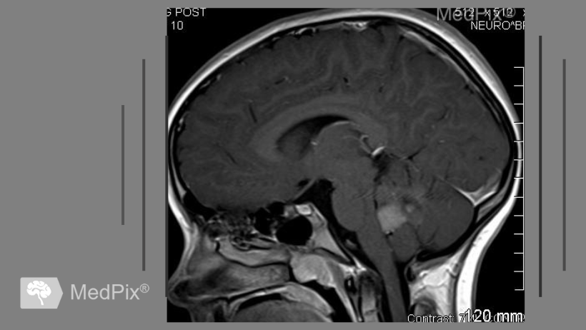 Brain MRI with medulloblastoma