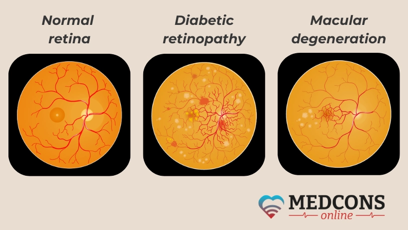 Magnified images of normal retina, in diabetic retinopathy, and in macular degeneration   