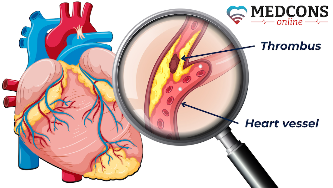 Heart vessel blocked due to atherosclerosis