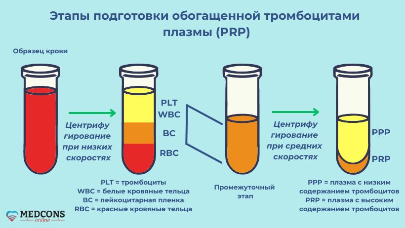 Этапы изготовления препарата для PRP-терапии: предварительное и окончательное центрифугирование с поэтапным выделением компонентов