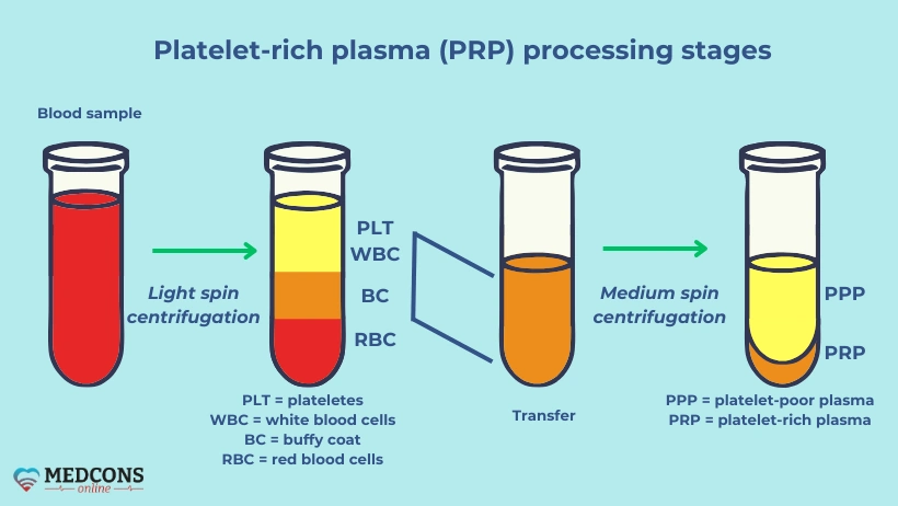 Stages of PRP drug preparation: preliminary and final centrifugation with step-by-step separation of components